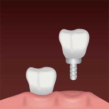 tooth implant benefits