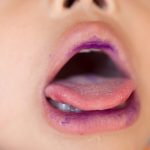Causes OF Baby Mouth Ulcer