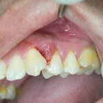 Gum Boil Causes, Types and Management