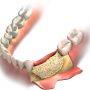 Tips for Speedy Dental Bone Graft Recovery