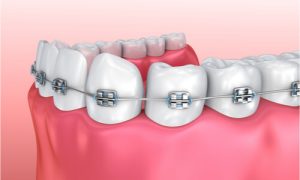 braces for bottom teeth