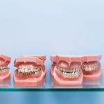 Types Of Malocclusion: Understanding Each Condition And Treatment